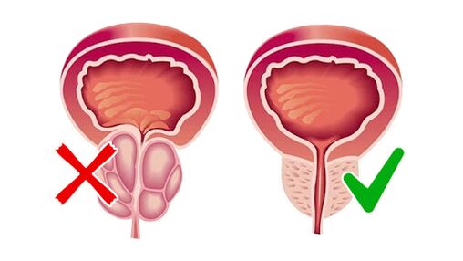 Prostate before and after using prostate