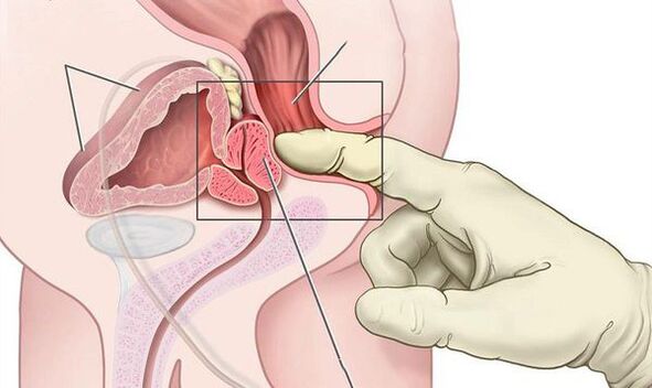 digital rectal examination of the prostate